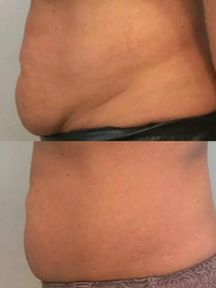 Lipocavitação Corporal