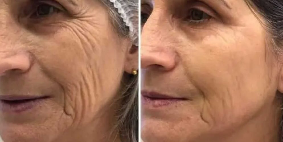 Radiofrequência Facial