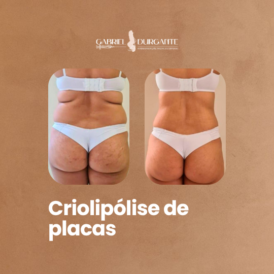Criolipólise De Placas - Redução De Gordura Localizada