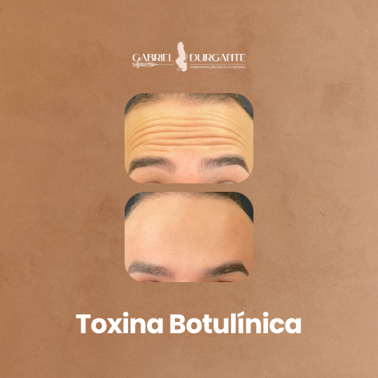 Botox - 290,00 A Região