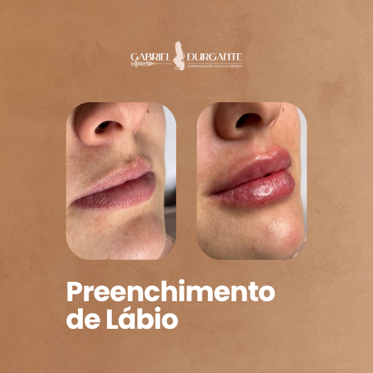 Preenchimento Labial 1ml